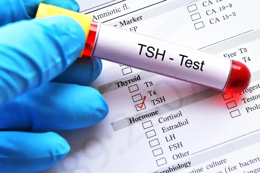 Examen TSH utilizado para evaluar la función tiroidea y detectar alteraciones hormonales en Beatlab Rancagua.
