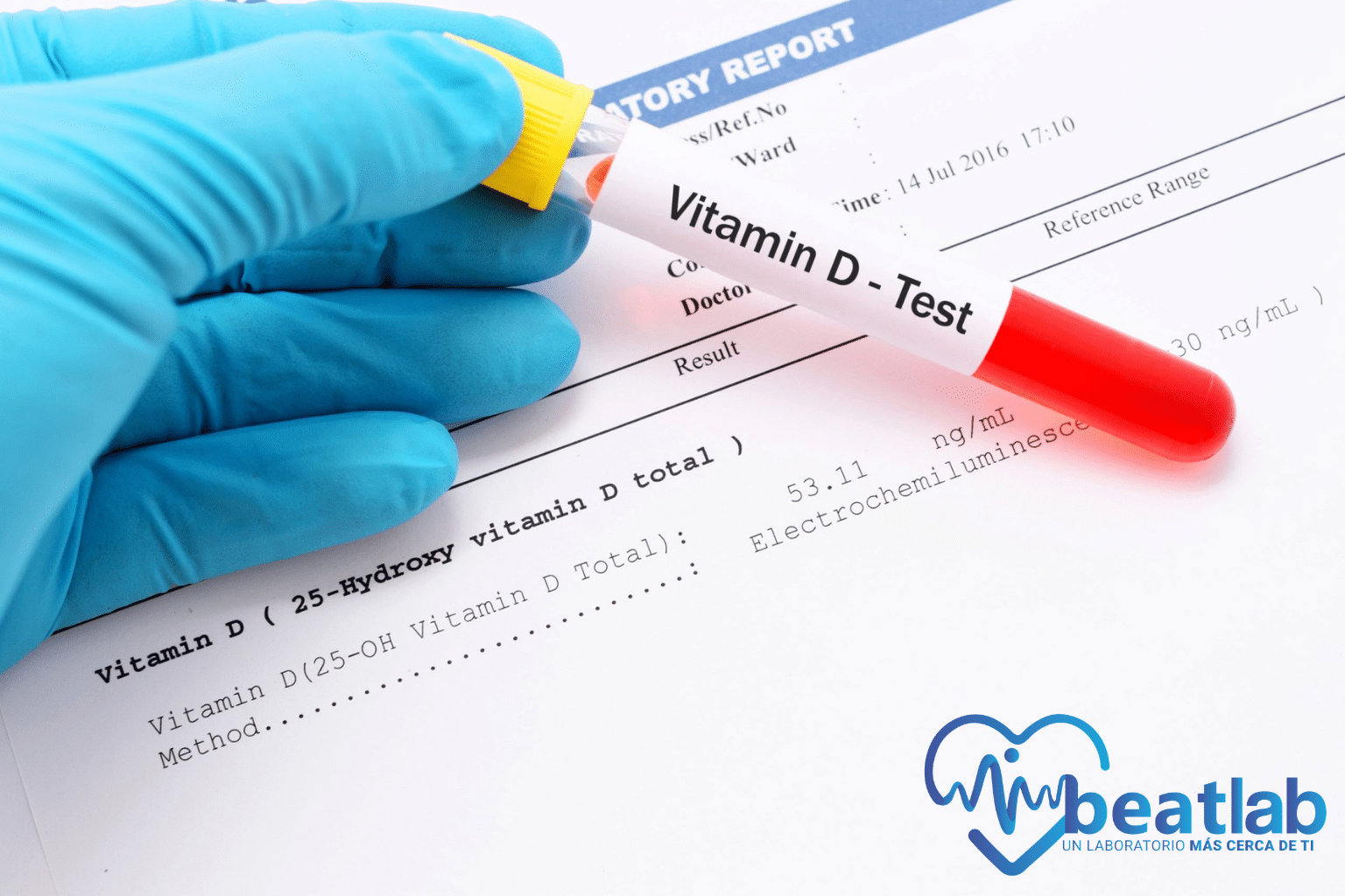Muestra de sangre para examen de vitamina D sobre informe de laboratorio clínico en Beatlab Rancagua.