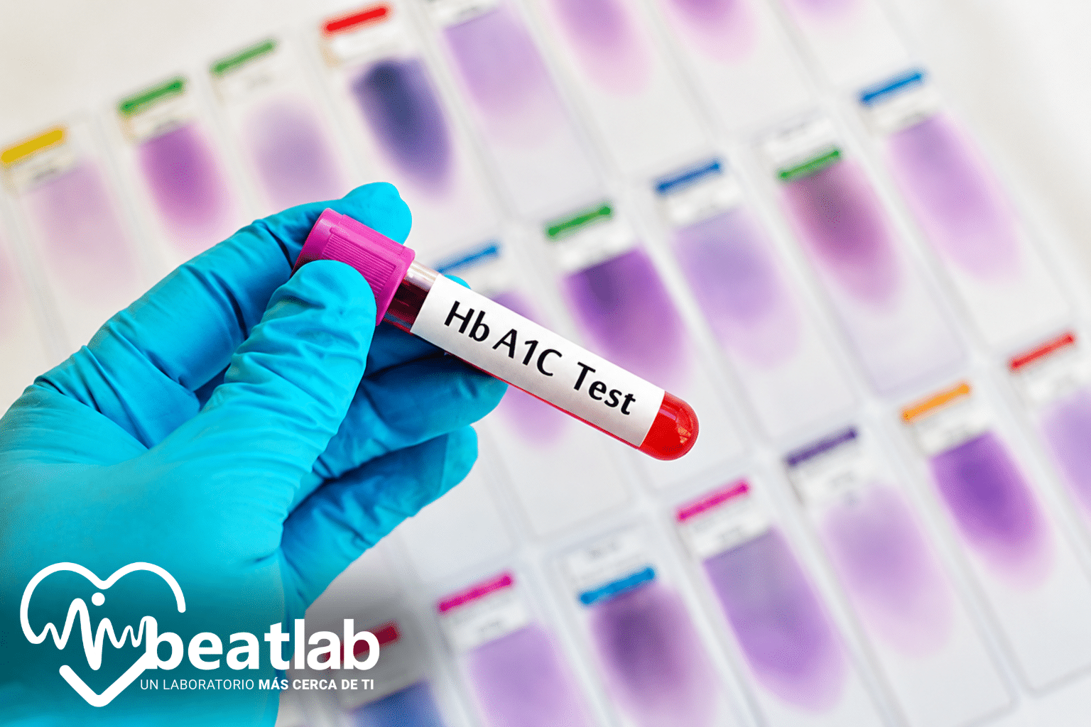 Tubo de muestra para examen de Hemoglobina Glicada HbA1c realizado en laboratorio clínico Beatlab Rancagua.
